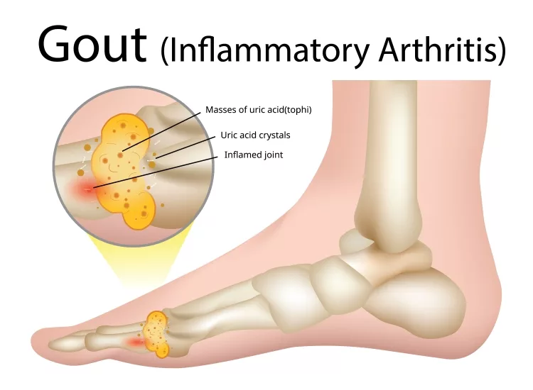 Inflammatory Arthritis