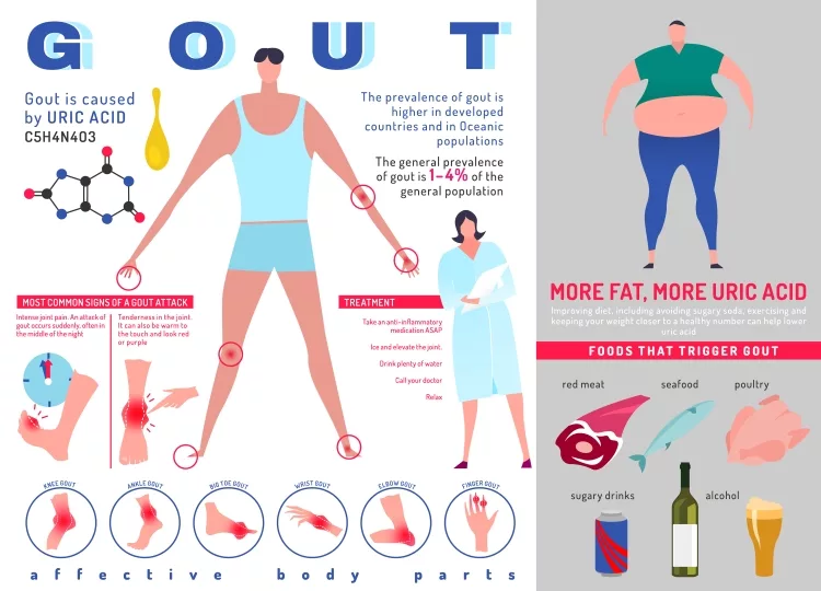 Gout arthritis infographic