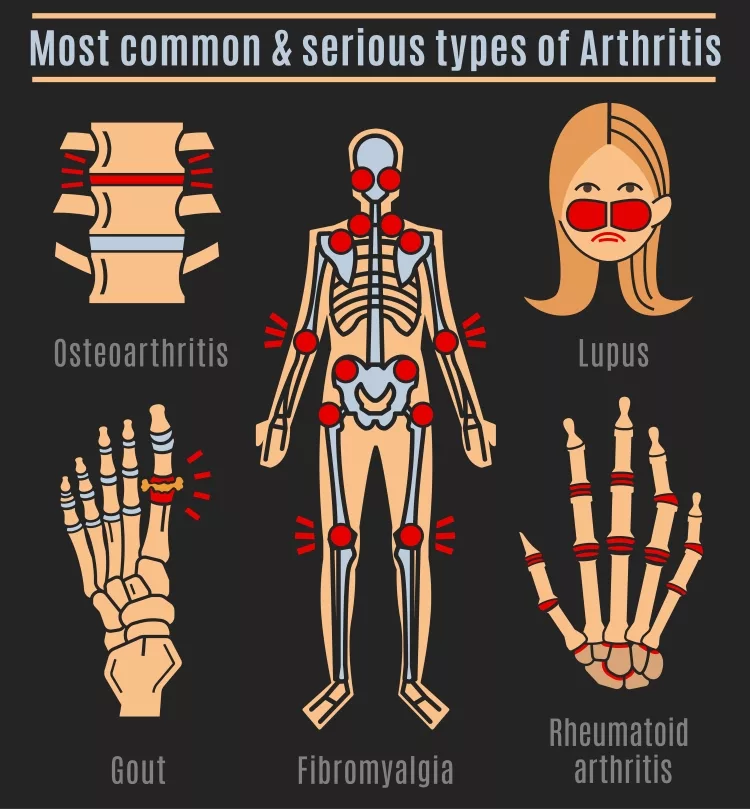 Arthritis types infographic
