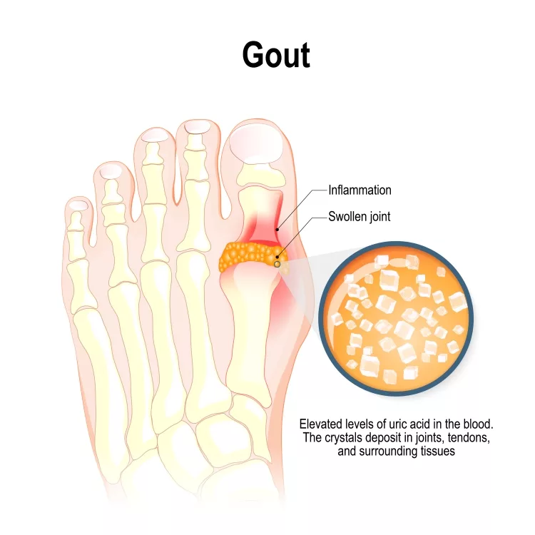 Gout is a form of inflammatory arthritis