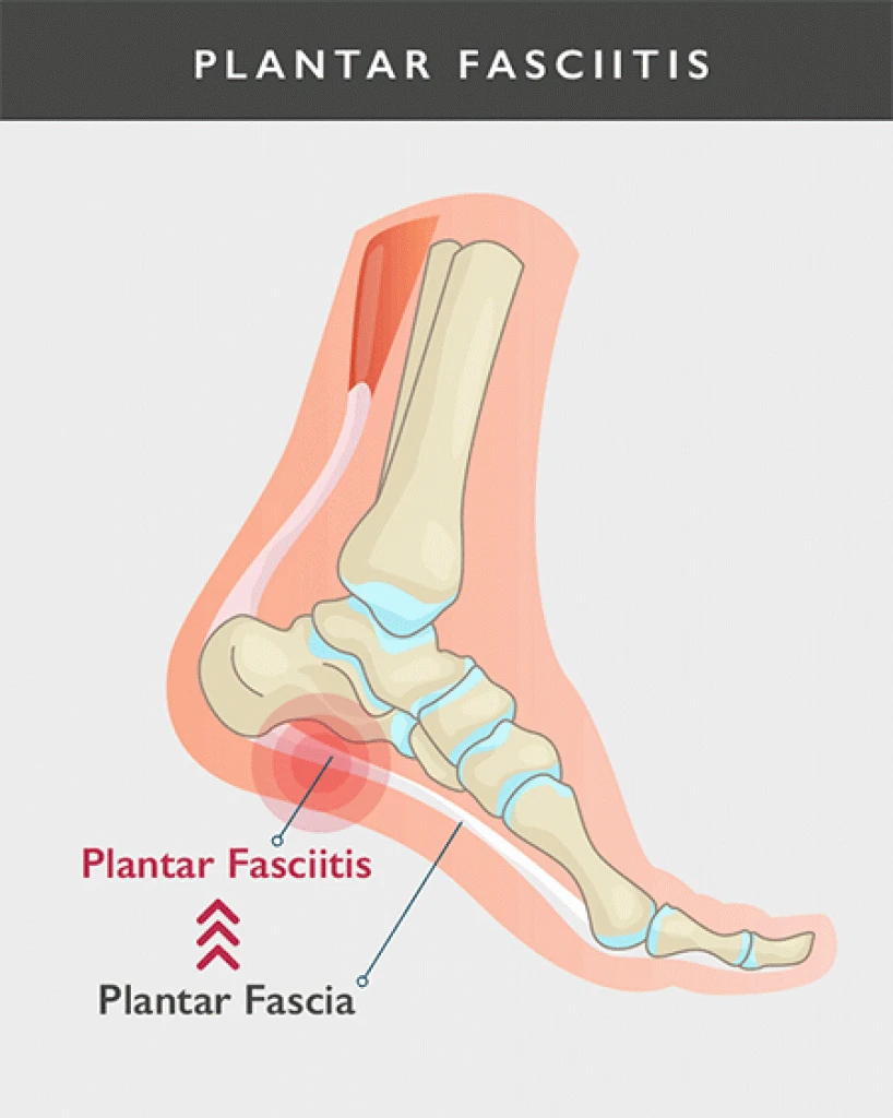 What is Plantar Fasciitis?