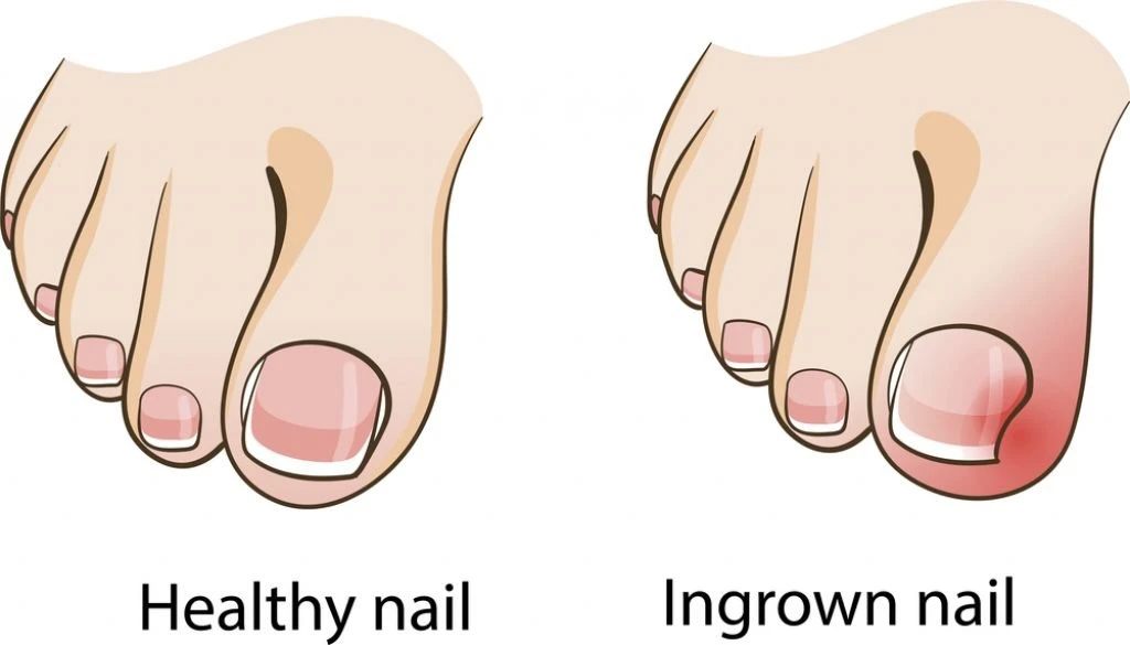 Ingrown Toenails