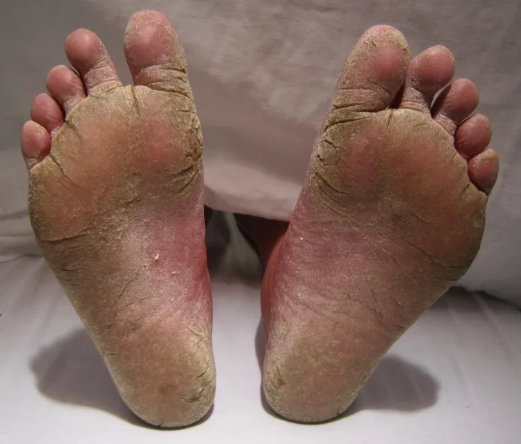 5 Killer Ways To Treat Athlete’s Foot