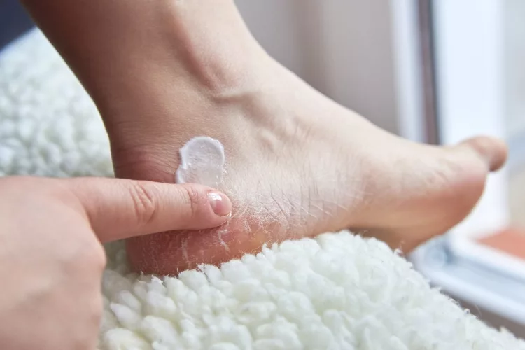 Best Foot Cream for Cracked Feet