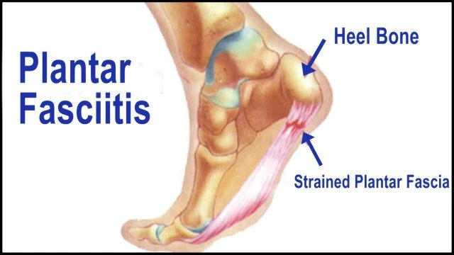 Plantar Fasciitis Condition