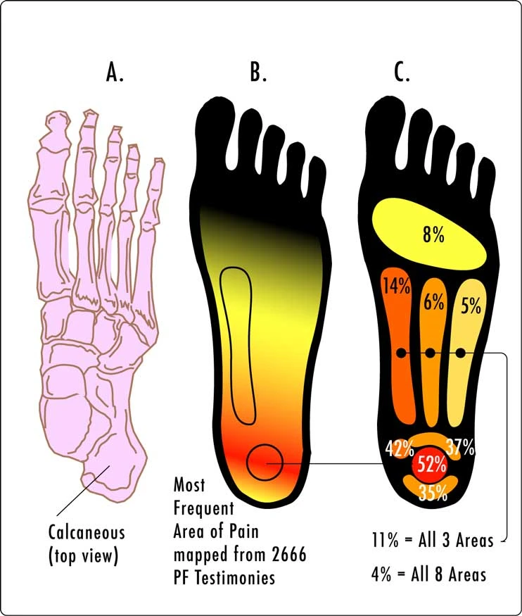 Plantar Fasciitis