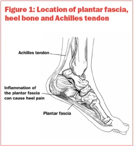 Treatment Of Plantar Fasciiatis